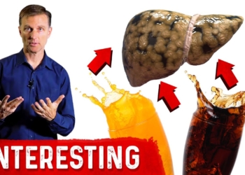 Soft Drinks and Fatty Liver Disease: Interesting