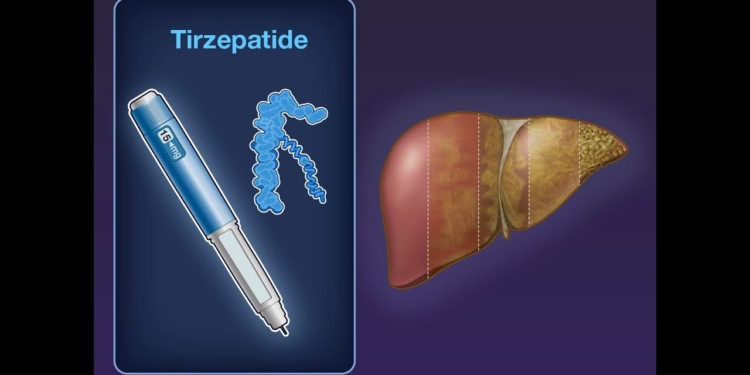 Tirzepatide for MASH with Liver Fibrosis | NEJM