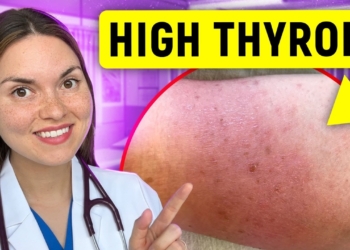 19 Signs of HYPERTHYROIDISM (Graves Disease) You Can See: Doctor Explains