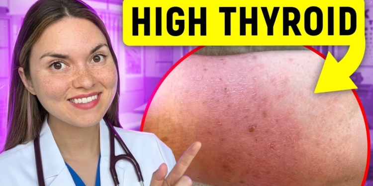19 Signs of HYPERTHYROIDISM (Graves Disease) You Can See: Doctor Explains