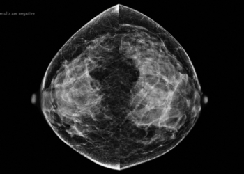 AI Strategy Could Eliminate Radiologist Review of Low-Risk Mammograms