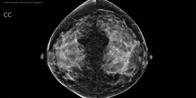 AI Strategy Could Eliminate Radiologist Review of Low-Risk Mammograms