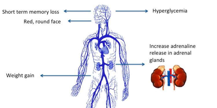 All you need to know about: Cushing’s syndrome