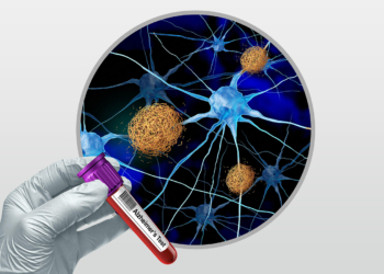 Alzheimer's Blood Tests Together Improve Accuracy, Cut Overdiagnosis