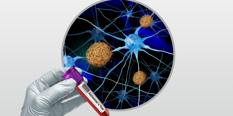 Alzheimer's Blood Tests Together Improve Accuracy, Cut Overdiagnosis