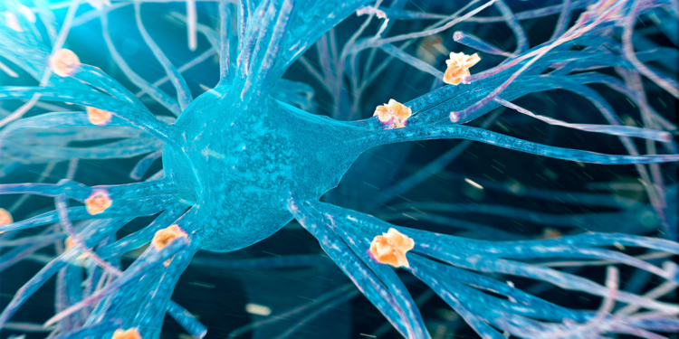 Alzheimer's Disease Advances Differently in Women