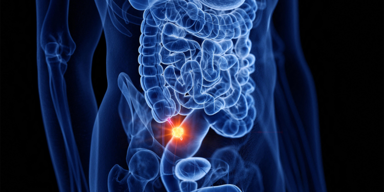 Are We Missing Tumors When Using Antibiotics Alone for Appendicitis?