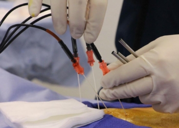 Beyond pills and surgery: how radiofrequency ablation is helping chronic pain sufferers