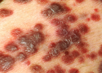 CDC Study Warns on Infection-Related Cancers After Organ Transplant