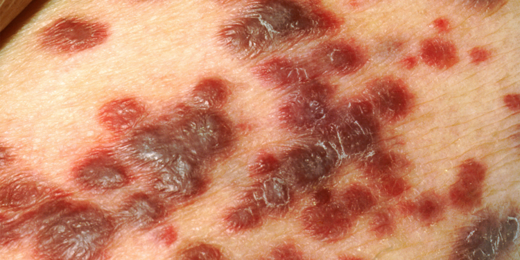 CDC Study Warns on Infection-Related Cancers After Organ Transplant