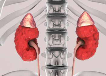 Drug Cuts Albuminuria in Type 1 Diabetic Kidney Disease, Too