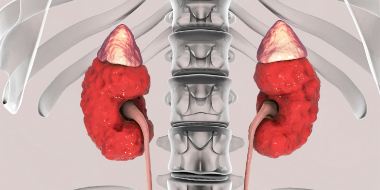Drug Cuts Albuminuria in Type 1 Diabetic Kidney Disease, Too