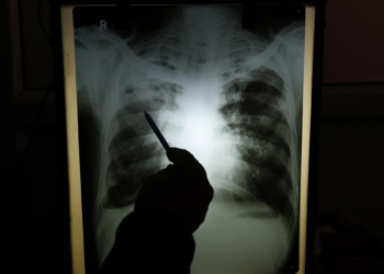 Drug-resistant TB poses a health emergency in India