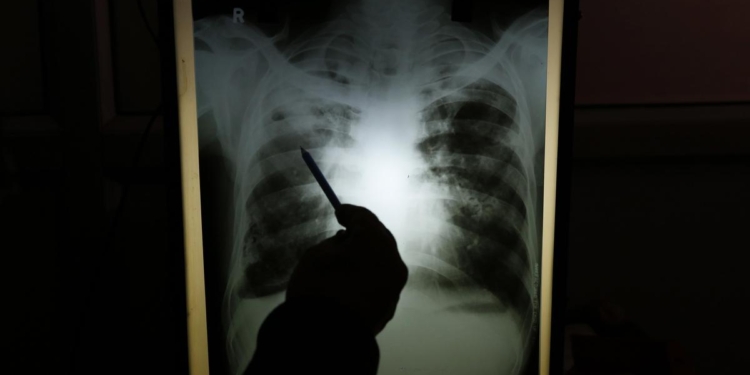 Drug-resistant TB poses a health emergency in India