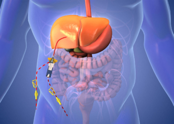 Dual Immunotherapy and Liver Perfusion Delays Progression in Uveal Melanoma