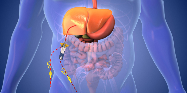 Dual Immunotherapy and Liver Perfusion Delays Progression in Uveal Melanoma