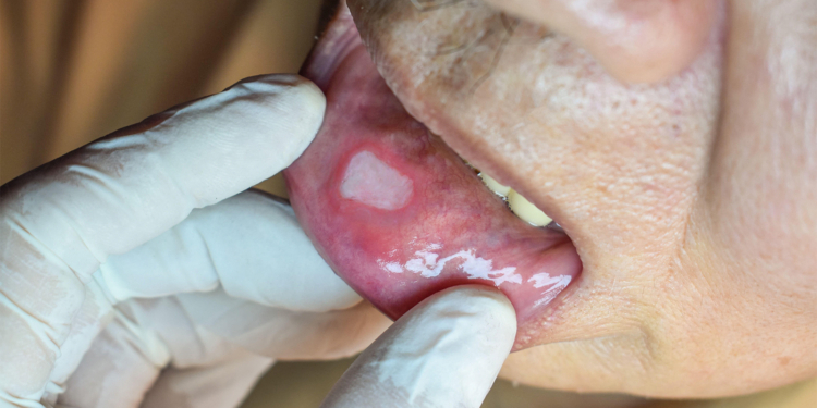 EULAR Updates Its Guidance on Managing Behcet's Syndrome