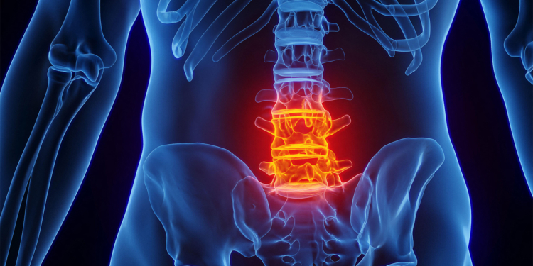 Europe Does Better Than U.S. in Treating Spondyloarthritis, Survey Data Suggest