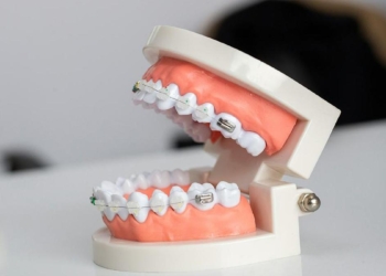 Experts call attention to health and developmental impact of overbite and underbite