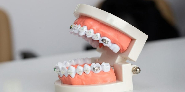 Experts call attention to health and developmental impact of overbite and underbite