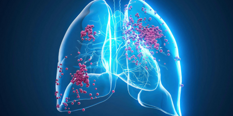 First-in-Class KRAS-Degrader Promising in Pancreatic, Lung Cancers