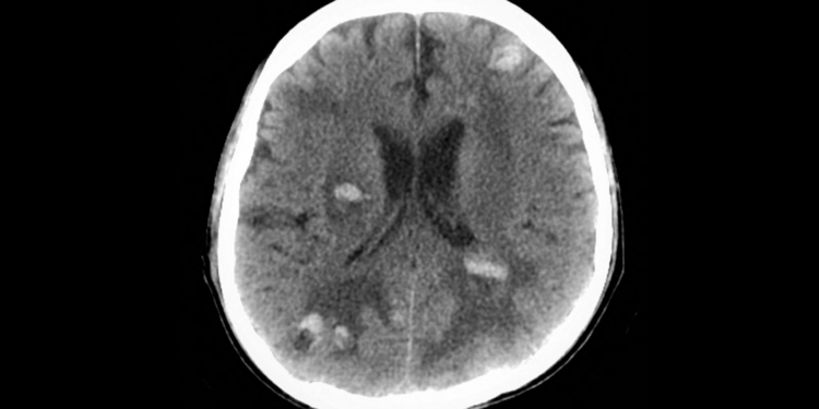 GLP-1 Drugs May Benefit Cancer Patients With Brain Lesions