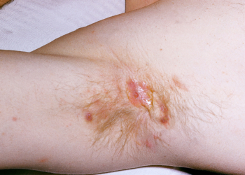 Hidradenitis Suppurativa Linked to Higher Risk of Self-Harm, Including Suicide