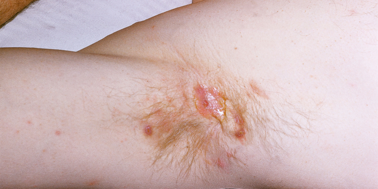 Hidradenitis Suppurativa Linked to Higher Risk of Self-Harm, Including Suicide