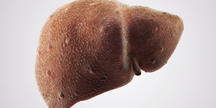 Higher Odds of Liver Fibrosis in Women With Cardiometabolic Risks