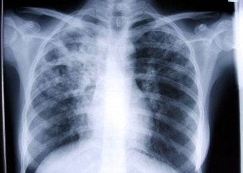 Human Writes: Keeping track of TB in our midst
