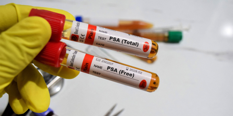 Low Testosterone May Raise Risk of 'Extreme' Prostate Cancer Progression