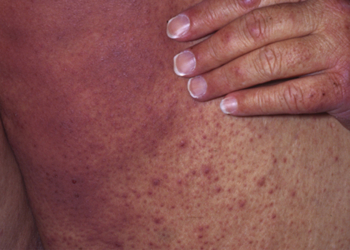 Make the Diagnosis: From a Bone Marrow Transplant to a Huge Rash. What’s Your Diagnosis?