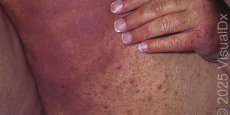 Make the Diagnosis: From a Bone Marrow Transplant to a Huge Rash. What’s Your Diagnosis?