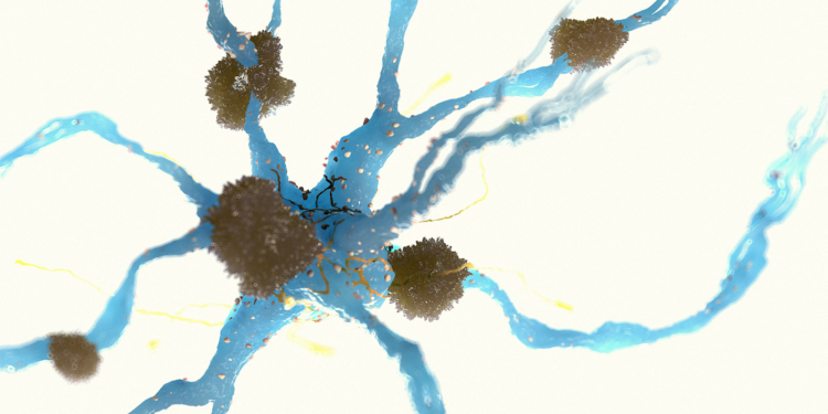 New Study Links Alzheimer's Findings to Old Medical Treatments