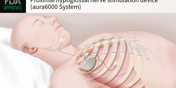 Next-Gen Nerve Stimulator Approved for Obstructive Sleep Apnea