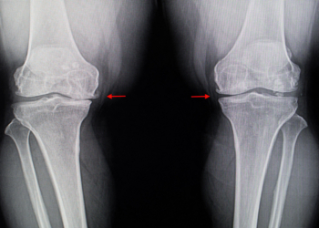Osteoarthritis: Promising Drug Therapy Flops