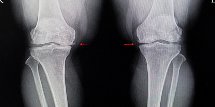 Osteoarthritis: Promising Drug Therapy Flops