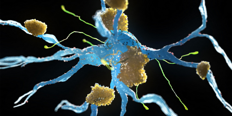 Parkinson's Protein Linked to Faster Alzheimer's Progression in Women