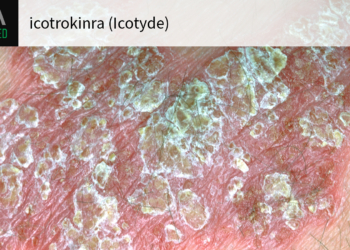 'Potential Game Changer' for Psoriasis Gets Green Light From FDA