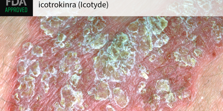 'Potential Game Changer' for Psoriasis Gets Green Light From FDA