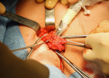 Sentinel Node Biopsy Improves Survival in Melanoma, Meta-Analysis Shows