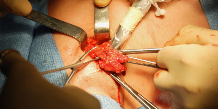 Sentinel Node Biopsy Improves Survival in Melanoma, Meta-Analysis Shows