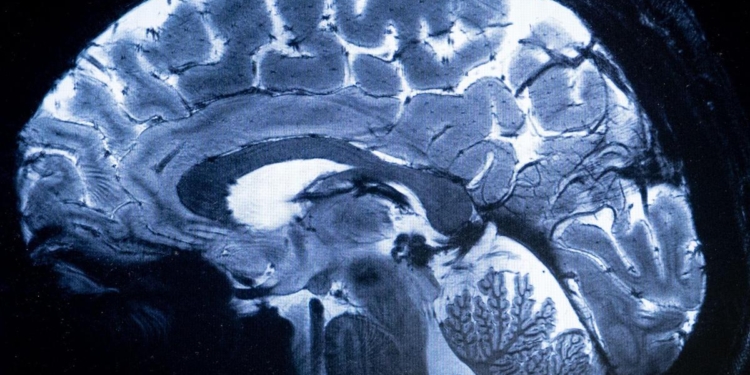 Study finds new biomarker for cognitive symptoms of schizophrenia, could serve as drug target