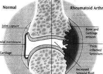 Study indicates incidence of rheumatoid arthritis increased 13% since 1990