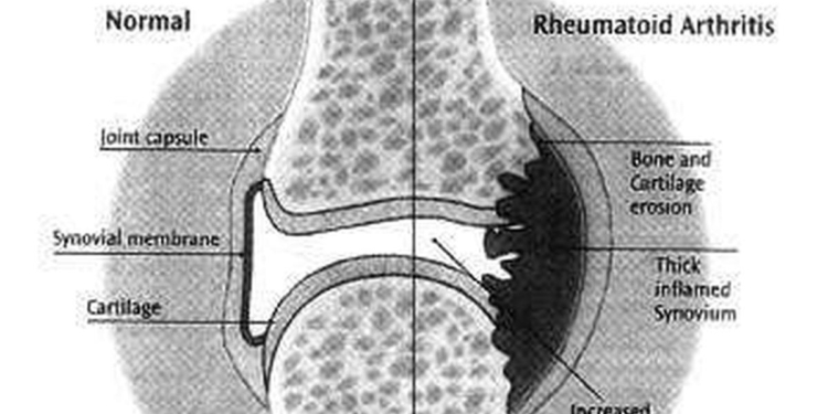 Study indicates incidence of rheumatoid arthritis increased 13% since 1990