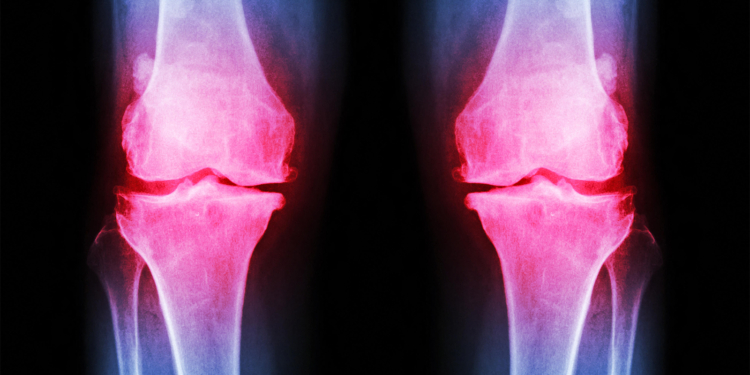 Trial Breathes New Life Into Neurotrophins as Target in Osteoarthritis