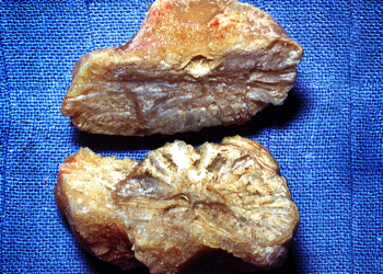 Trial Questions Fluid Intake Targets for Preventing Urinary Stone Recurrence