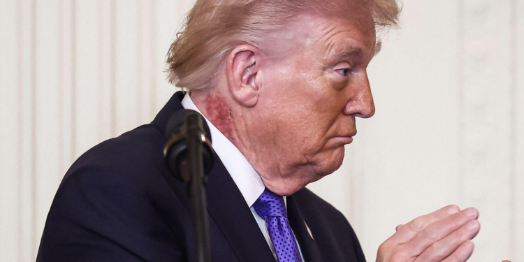 What Cream Is Trump Using on His Neck?