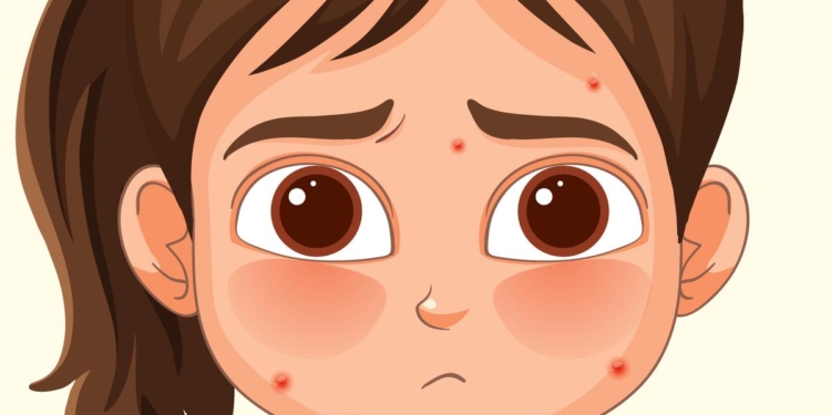 Why do we get chickenpox only once?