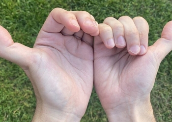 The health risks of being double-jointed